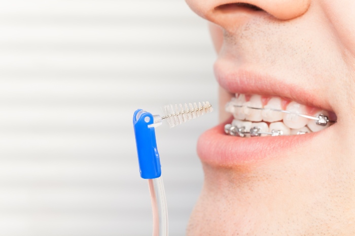 Signs You Need a Deep Dental Cleaning